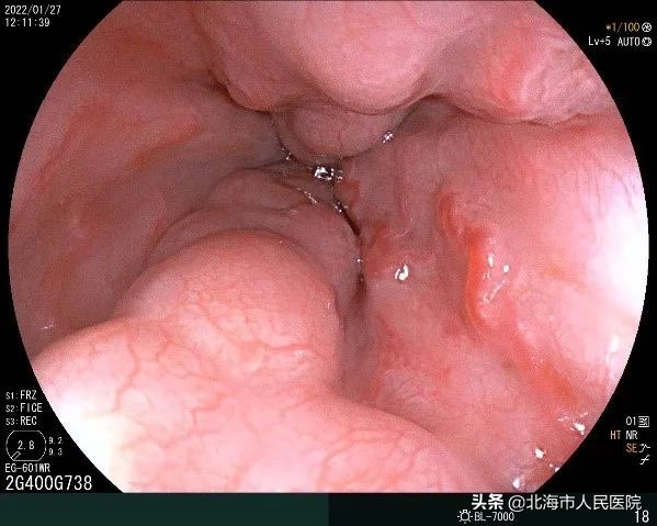 消化内科胃底静脉曲张治疗,消化内科静脉曲张手术费用