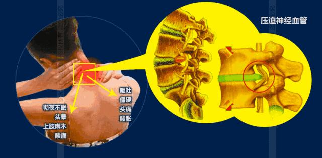 脖子两侧筋痛要警惕三种疾病,天生短脖子怎么改善