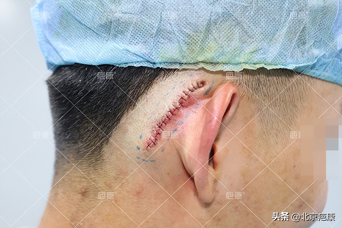 20岁小耳朵切除后恢复图片,耳朵增生疤痕疙瘩切除后要养多久
