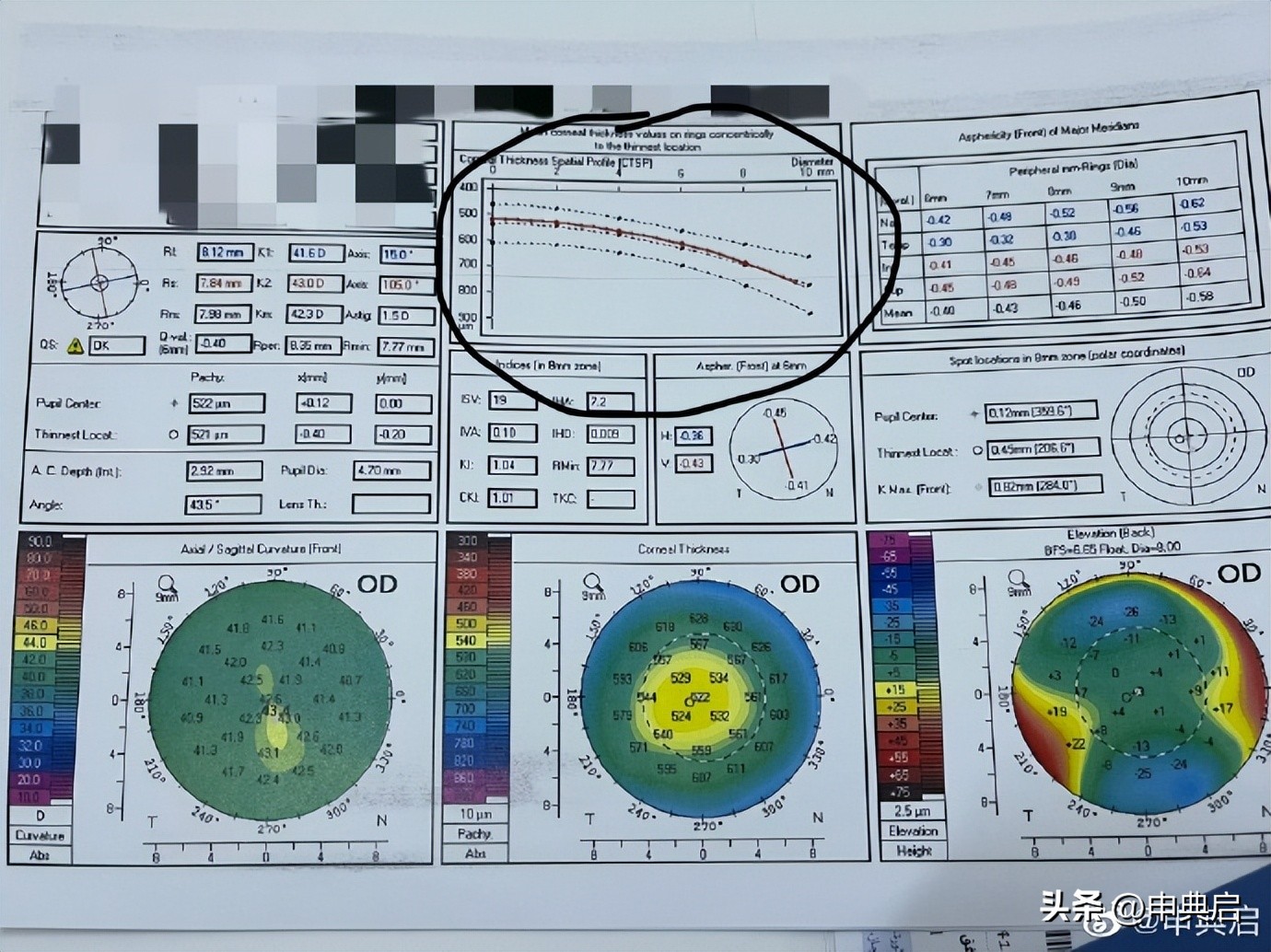 以色列近视手术多少钱,埃及做近视手术便宜吗