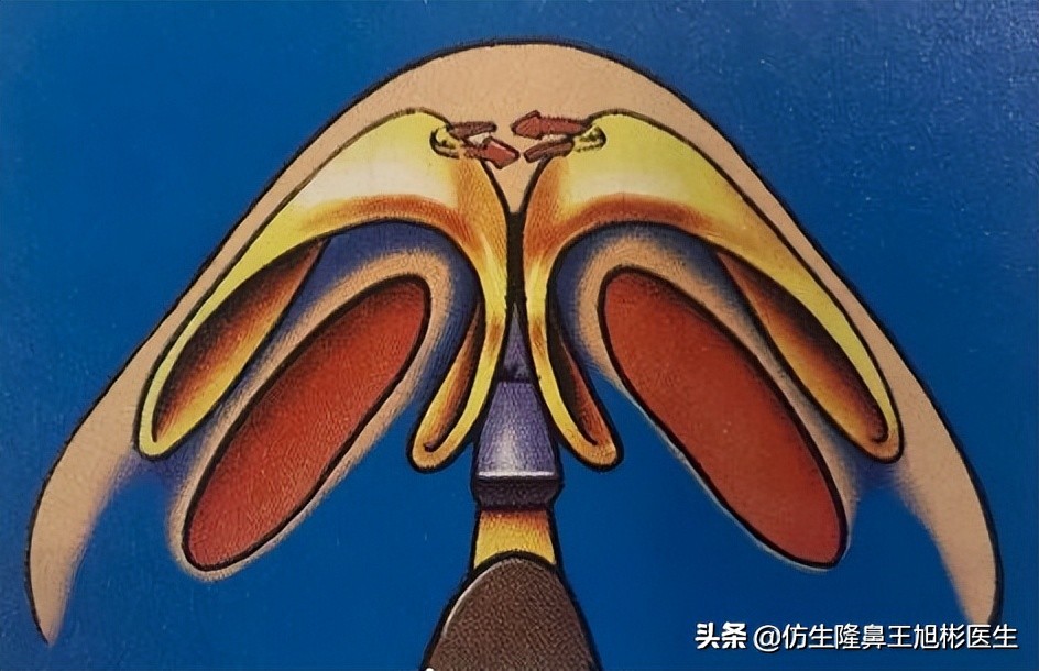 鼻头部位整形,鼻头圆钝高鼻梁整形案例