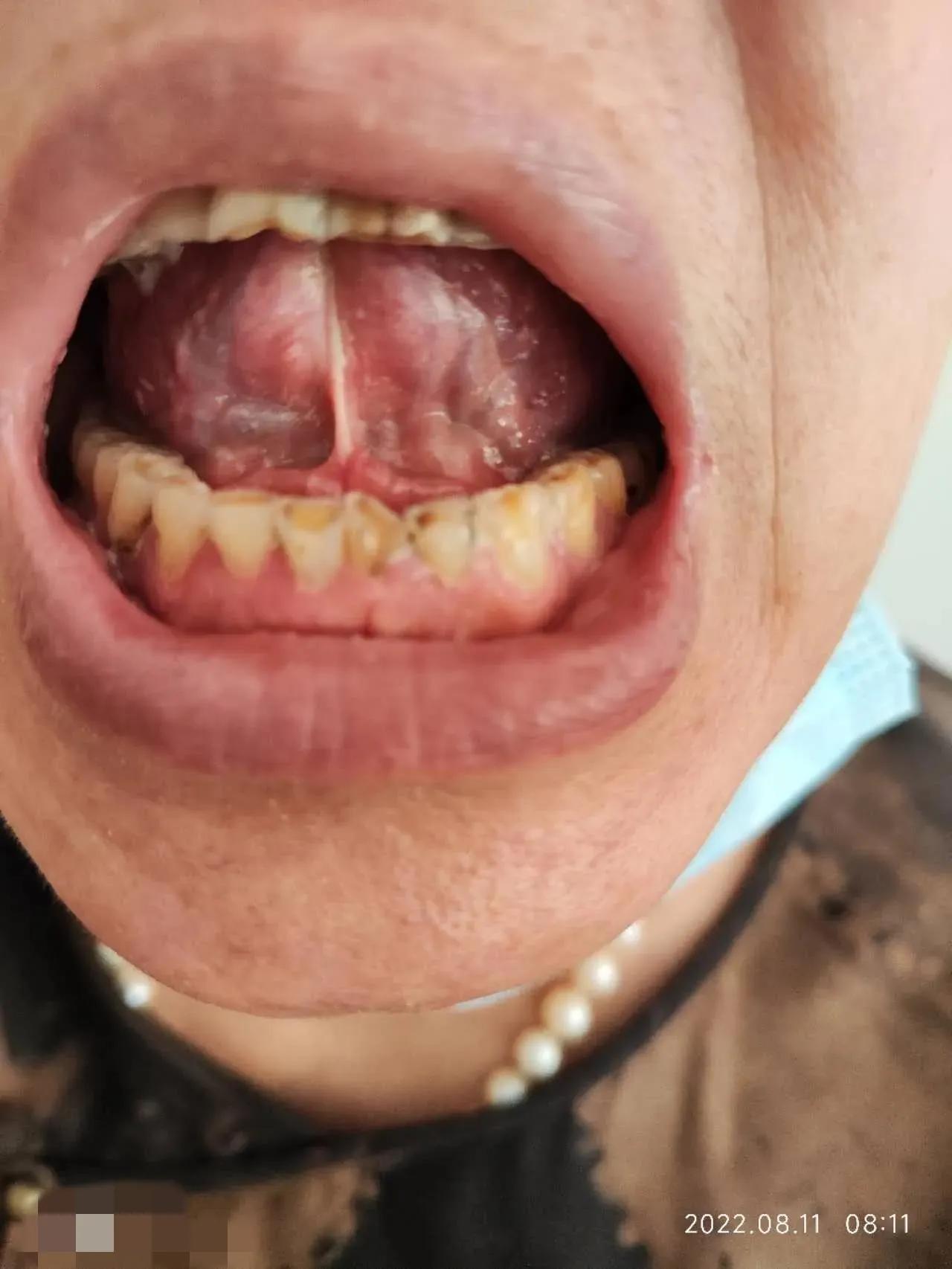 口服中药3个月，确诊5年的干燥综合征患者病情明显缓解