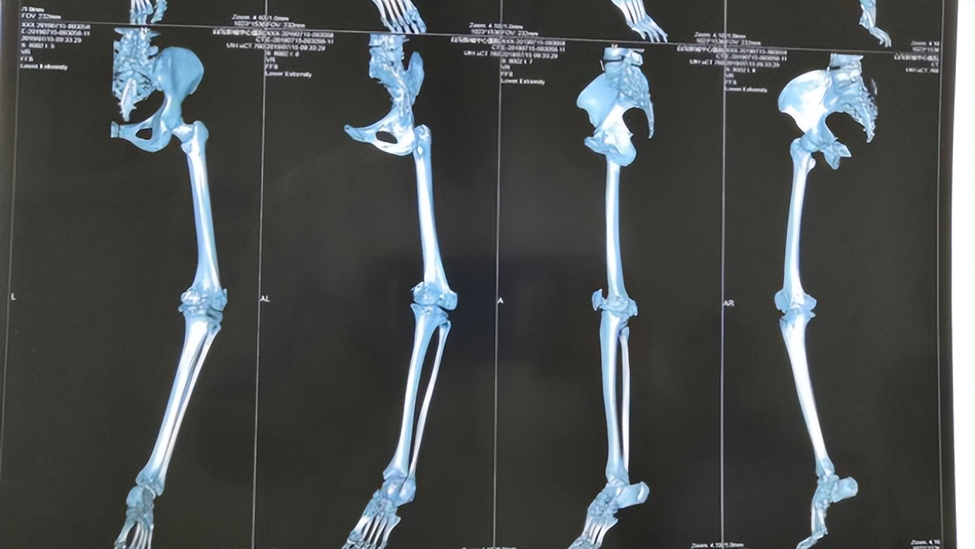 中老年膝盖半月板损伤的治疗方法,65岁老人半月板损伤膝盖痛
