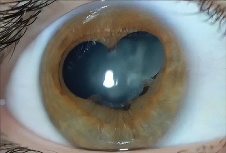瞳孔分裂成心形是什么症状,瞳孔突然变成三角