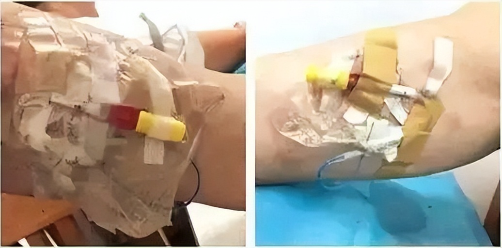 picc置管适用人群,picc置管自己能护理吗