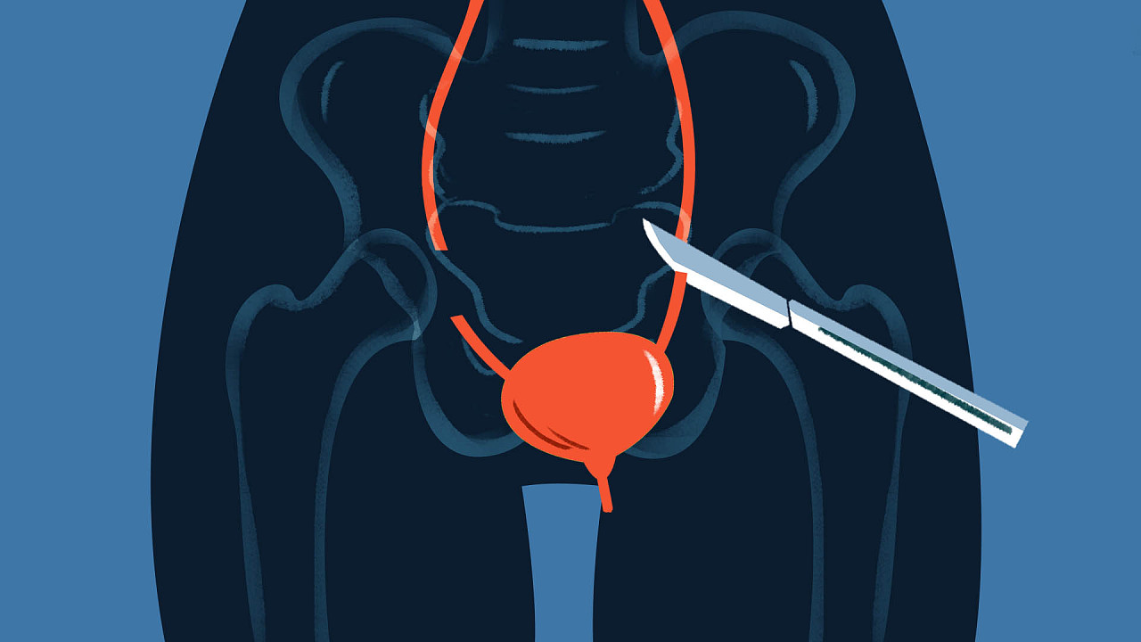 腹腔镜肾切除示意图,腹腔镜肾脏部分切除术