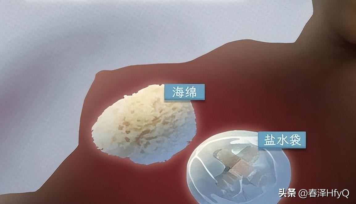 人类“隆胸”发展史：第一批“隆胸”的女人，后来都怎么样了？