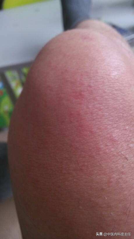 糖尿病浑身痒中药怎么调理,桂枝汤加减治疗糖尿病