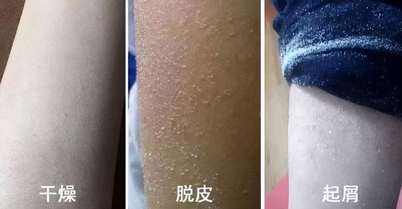 冬季皮肤皮屑满天飞,冬天来了皮肤干燥脱衣服有皮屑