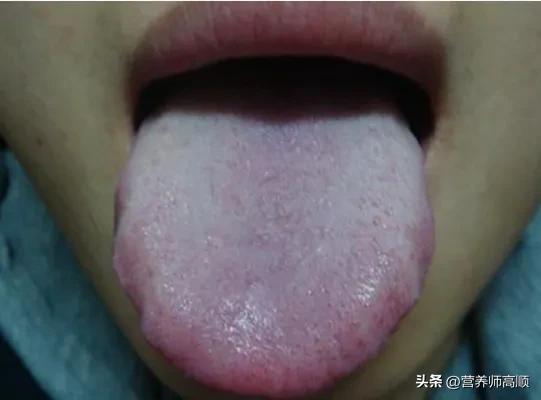 湿气要如何改善,湿气重怎么有效祛除湿气呢