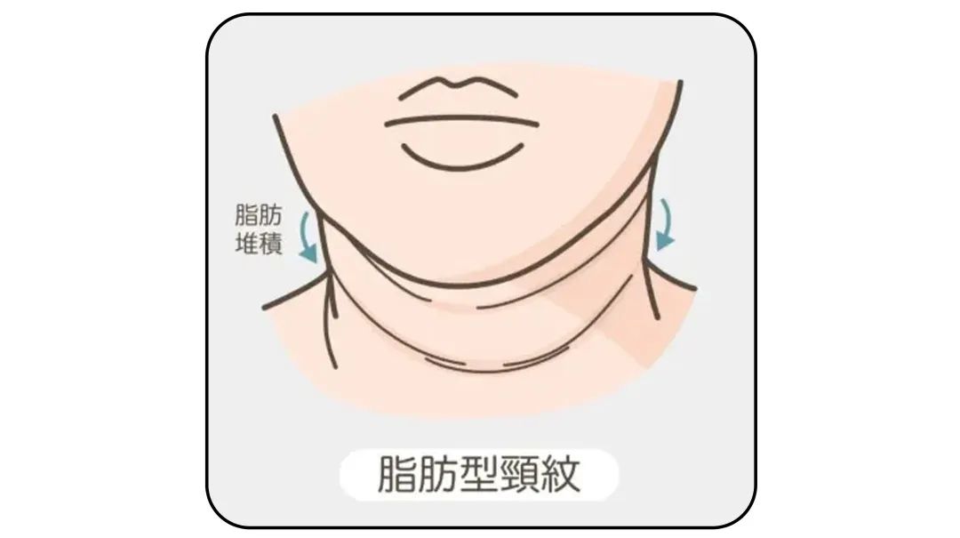 1条颈纹=显老10岁，可怕的颈纹还有救吗？