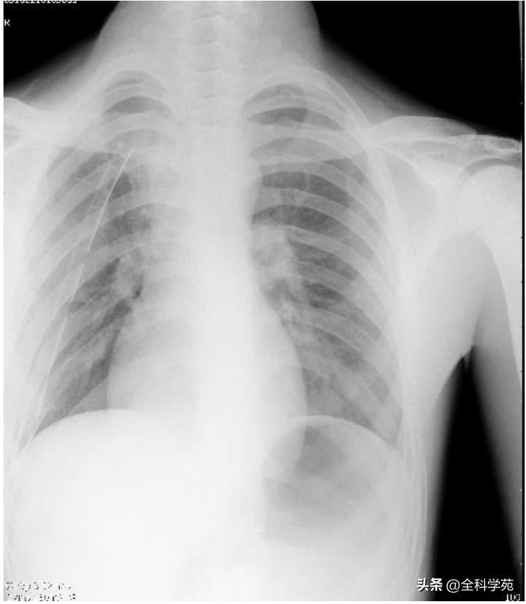 心电图qrs时限超宽是什么引起的,心电图qrs波呈m型见于什么疾病
