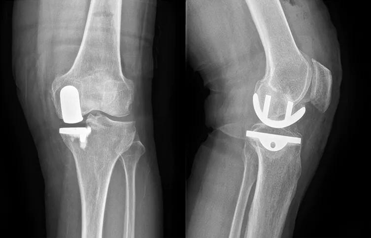 活动与固定平台单髁假体对膝关节前内侧骨关节炎的疗效比较