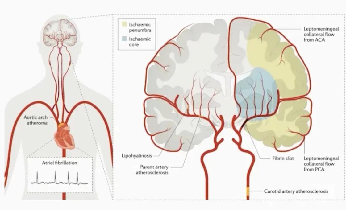 缺血性卒中治疗原则,缺血性卒中病因分型
