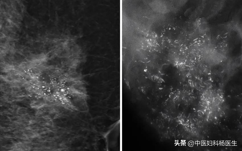 女子按摩致乳腺癌,医生说乳腺不能随便按摩