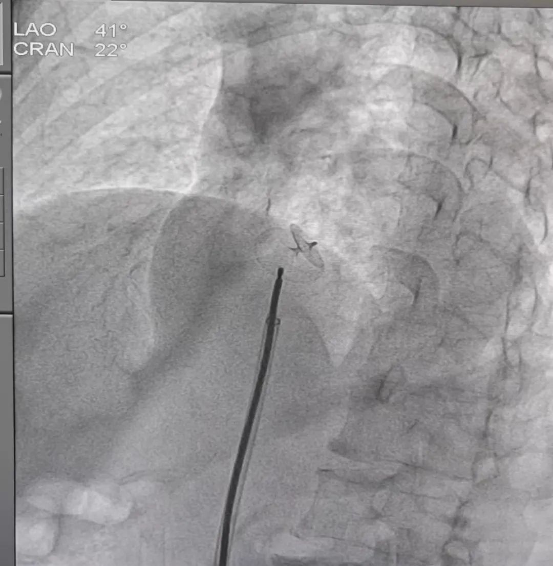 微创介入卵圆孔未闭封堵手术,齐鲁医院卵圆孔未闭封堵手术