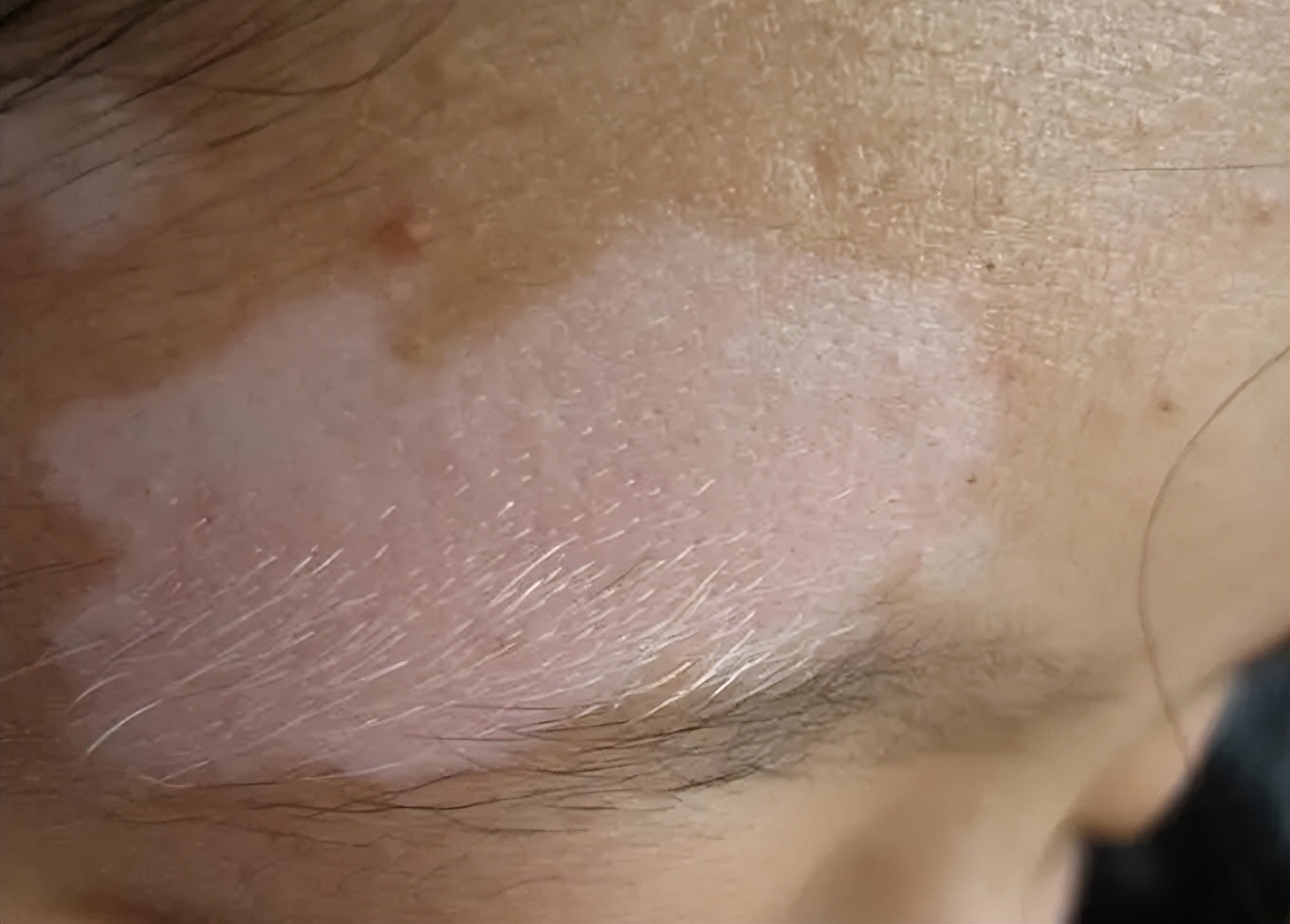 白癜风男孩患者真实记录,28岁小伙头部白癜风