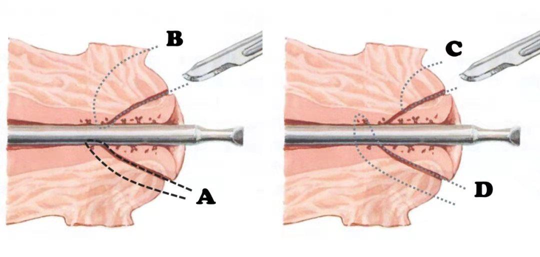派特灵生物讲解,派特灵用在宫颈的步骤