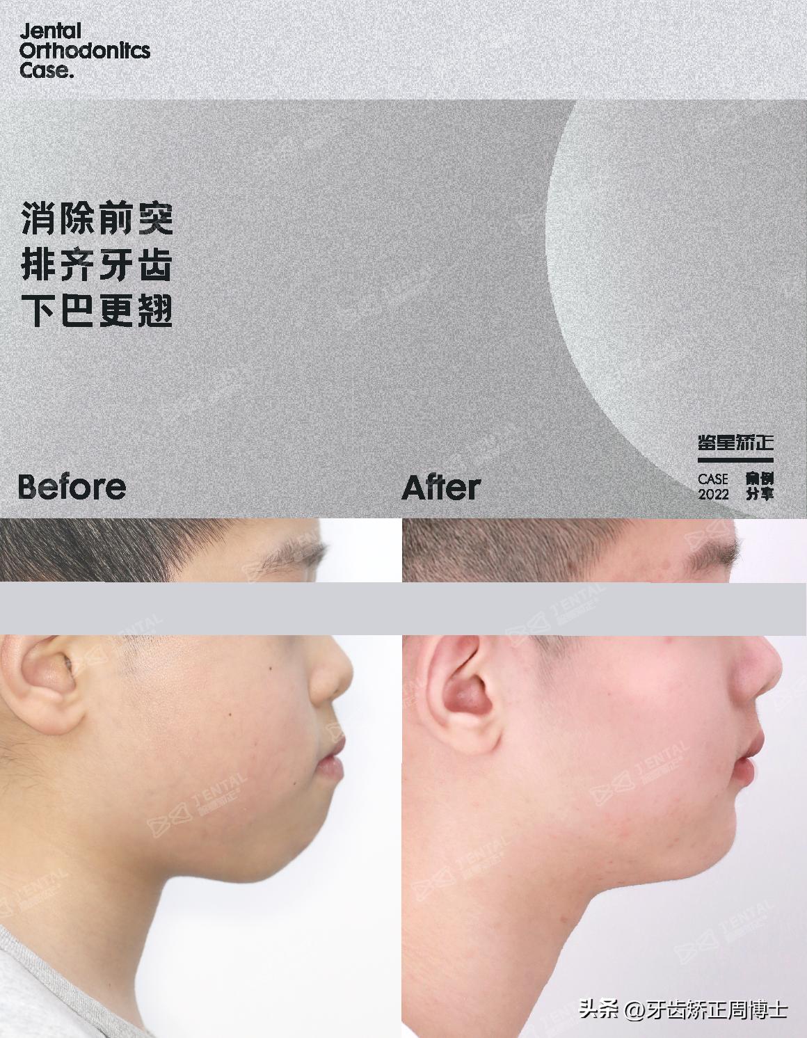 mrc戴上后不能闭上嘴怎么办,mrc矫正能用到几岁