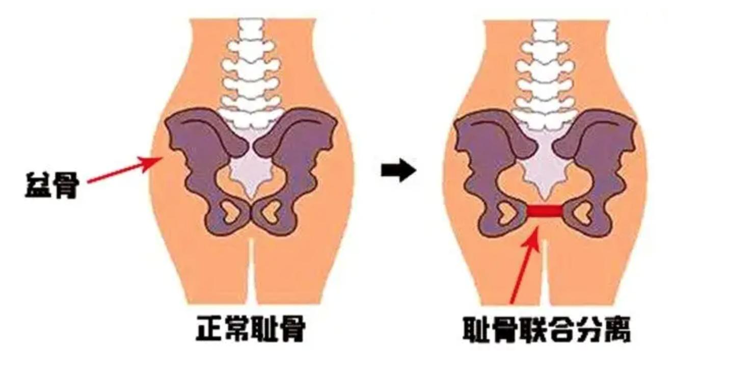 孕期尾椎骨和耻骨疼怎么缓解,孕期耻骨分离如何缓解