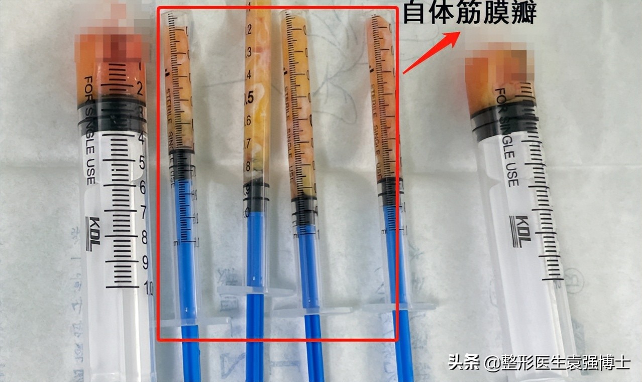 40岁就有很深的法令纹,40岁男士法令纹最新消除法