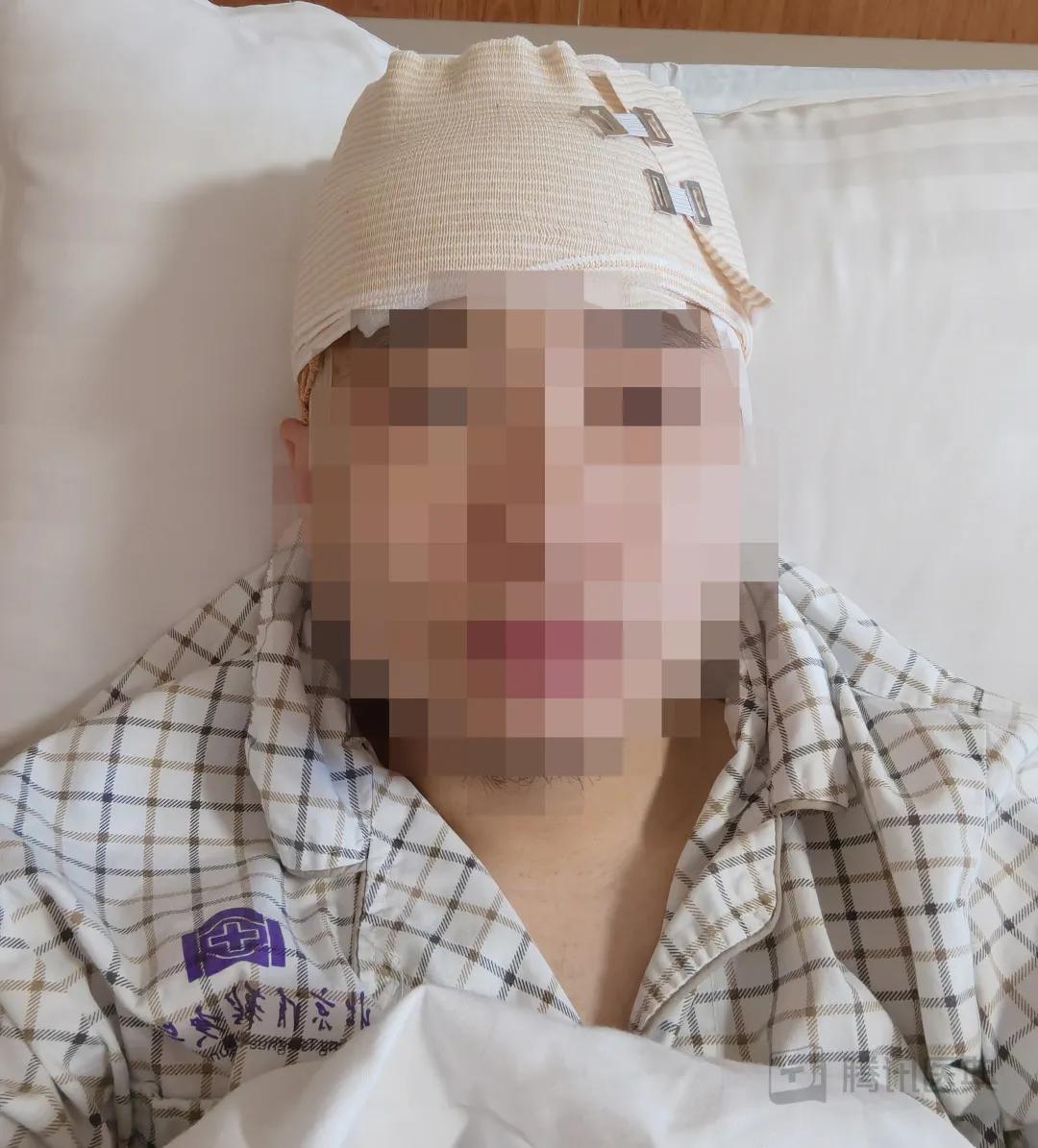 开颅手术后被掀开的头皮多久恢复,开颅手术掀开头皮头皮怎么恢复的