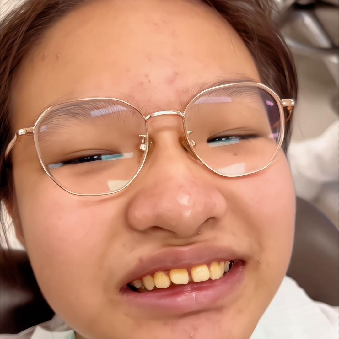 矫正牙齿拔牙开颌的全部过程,牙齿矫正拔牙后牙洞恢复过程图