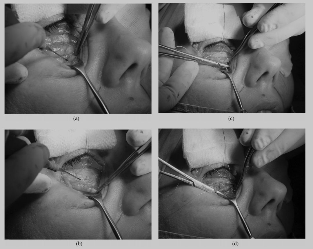 印第安纹解剖学,印第安纹分型对策