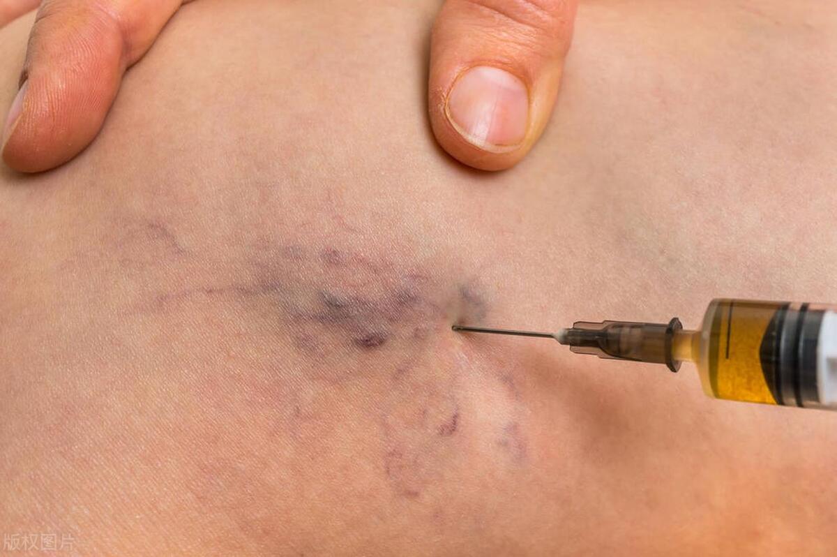 左腿静脉血栓是怎么回事,左腿静脉血栓是什么原因引起的