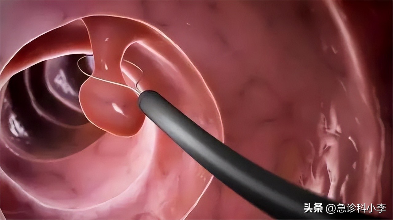 肠道为什么反复长息肉如何预防,如果肠道长息肉身体会有哪些反应