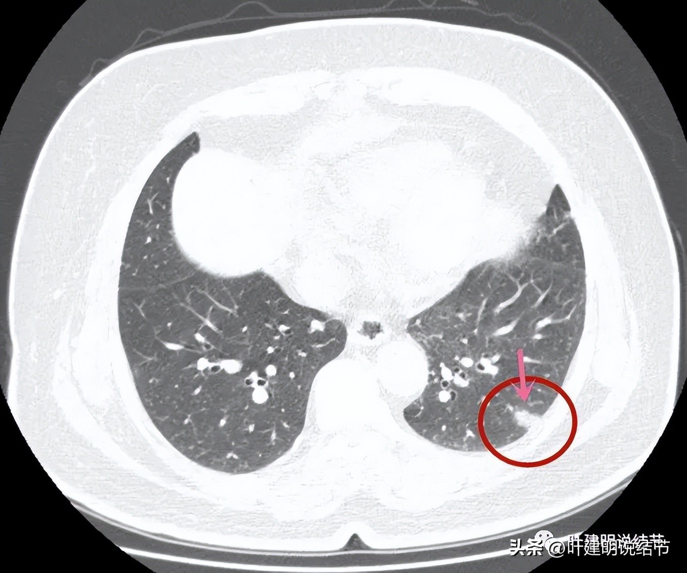 肺结节实性为什么建议抗炎治疗,肺上实性结节抗炎后变成空洞