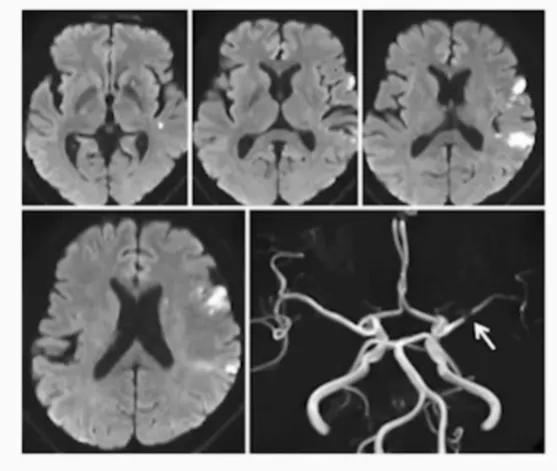 缺血性卒中治疗原则,缺血性卒中病因分型