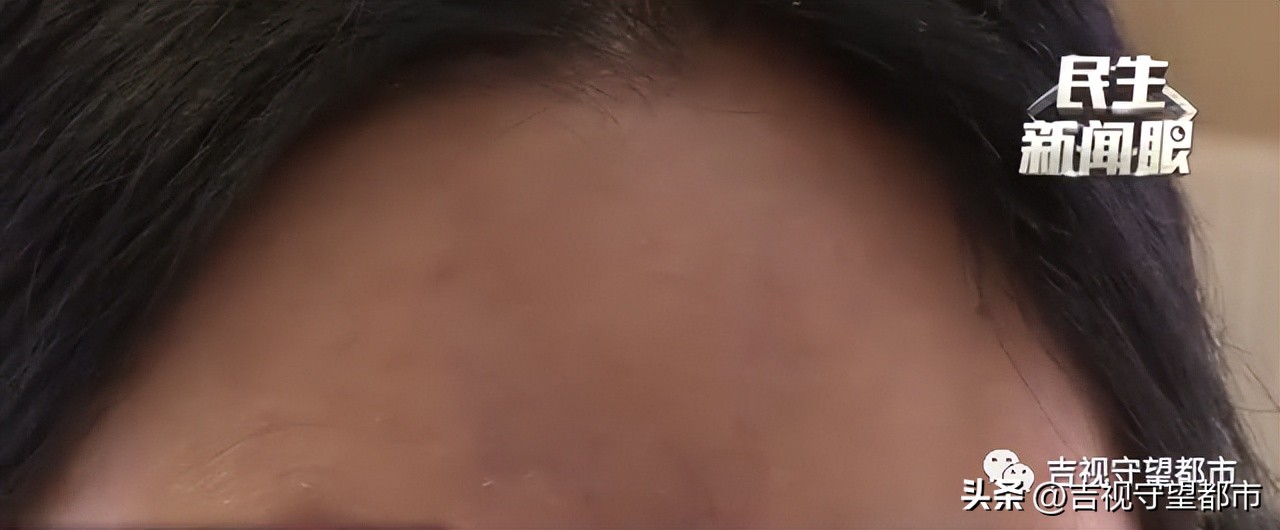 做完填充1年水肿,面部取出填充物手术