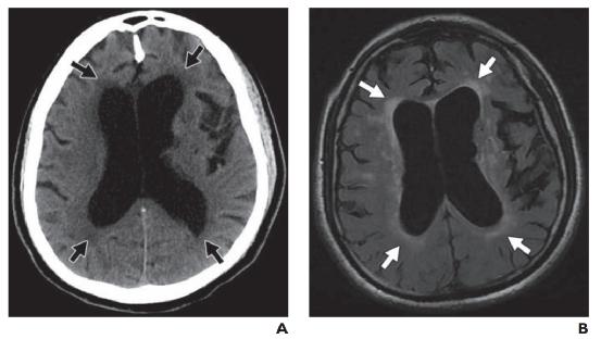 脑水肿的影像,脑水肿形成机制生理学