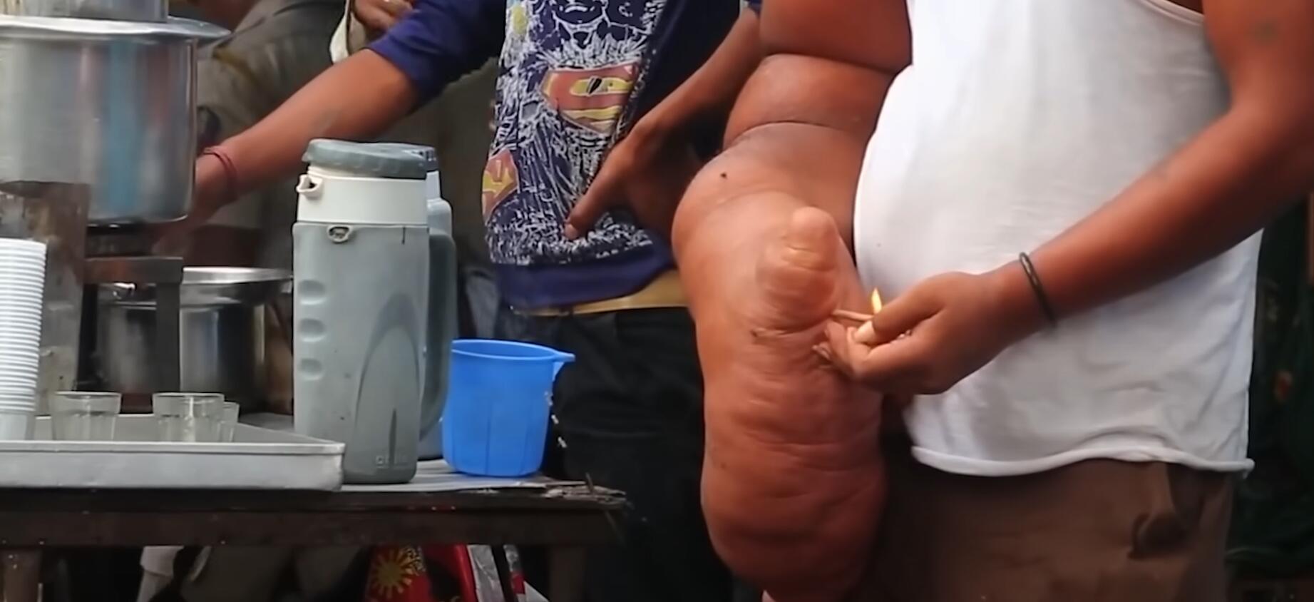 10个难以置信的人类，树皮人、外星人、拥有粗壮手臂的大力水手