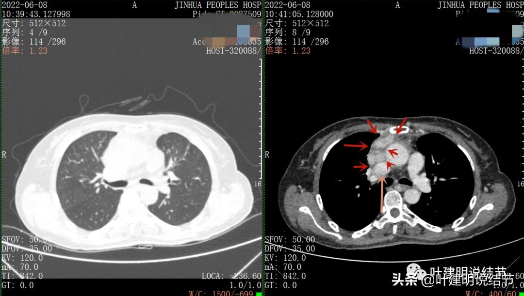 这位老乡，乏力来查，查出这么大个的纵隔肿瘤！会是什么呢？