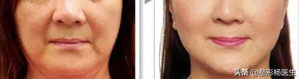 有法令纹特显老教你几招抚平细纹,法令纹这么显老得如何搞定