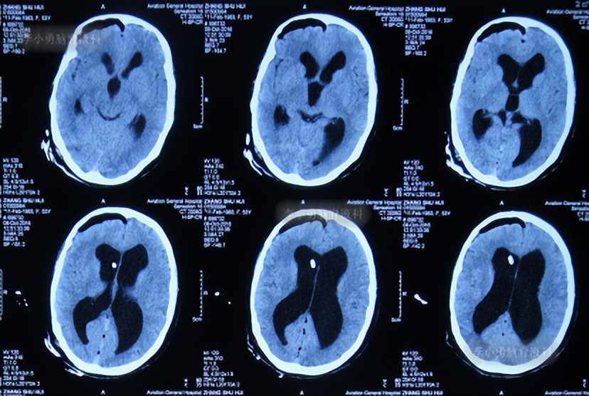 脑积水手术后4天还呕吐怎么回事,脑积水分流术后一直腹部疼痛