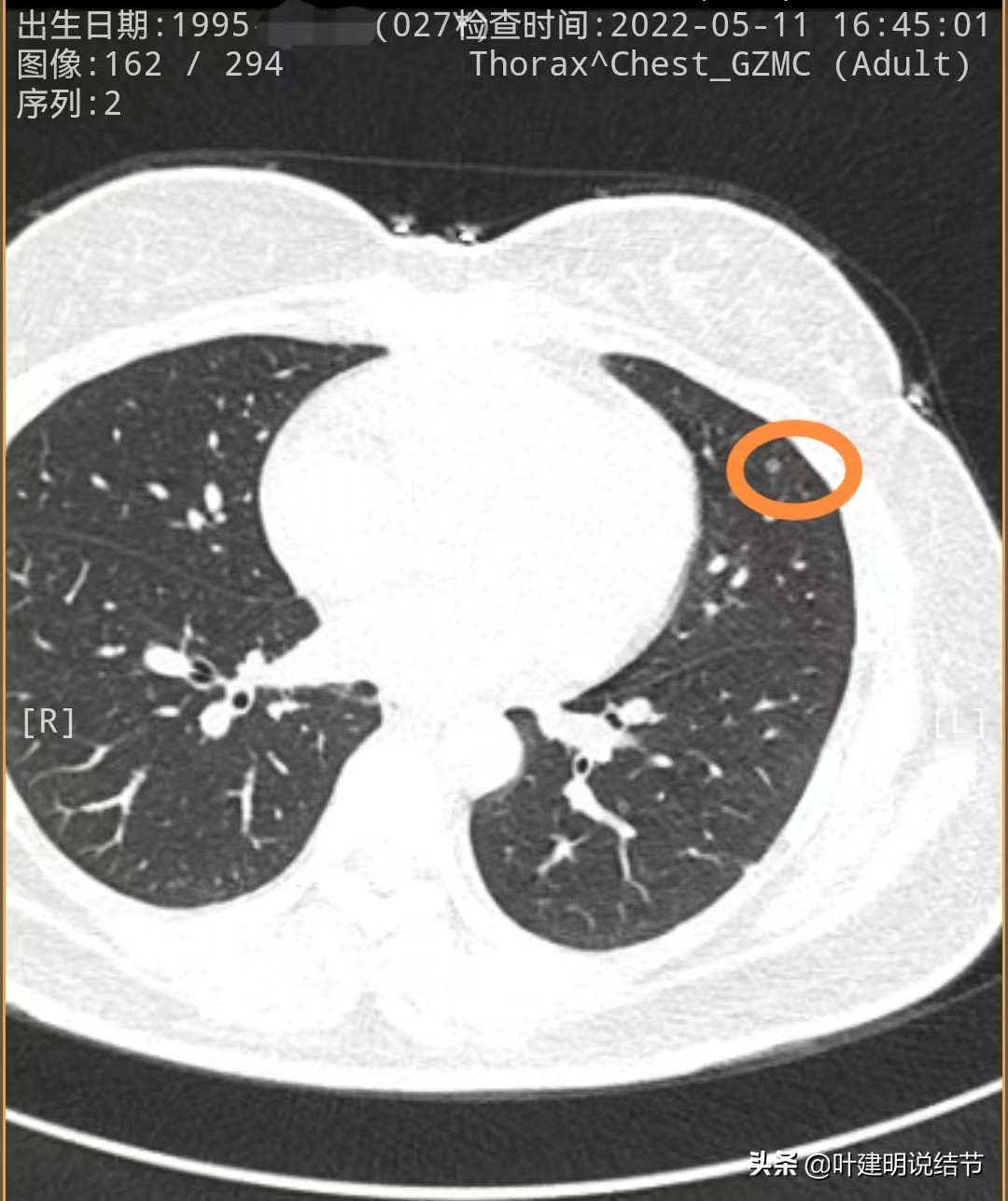 27岁女博士查出肺癌,年轻人多发肺结节怎么治愈