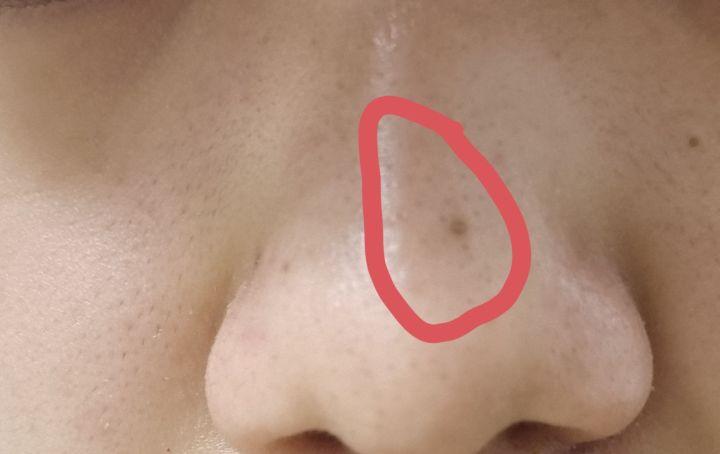 黑头没挤干净怎么办,黑头没及时处理变成黑痣了怎么办