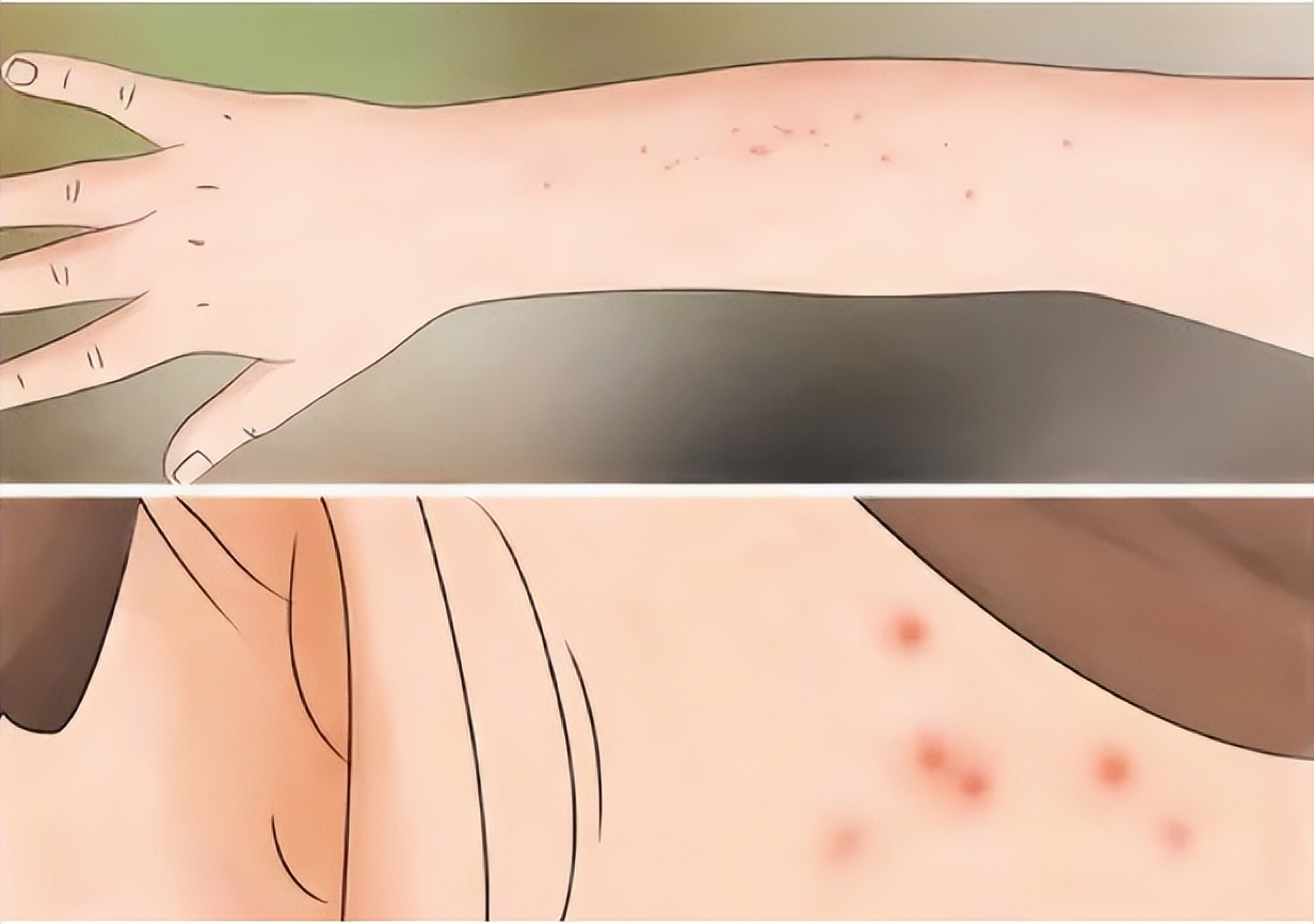 家里有床虱怎么彻底清除,如果被臭虫床虱咬了怎么办