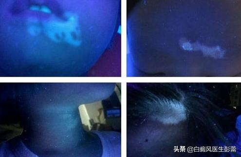 伍德灯下白斑颜色代表什么？一起来看看