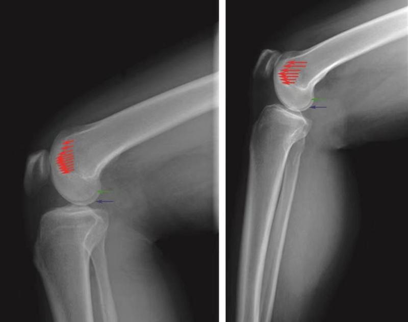 髌骨骨折评估,髌骨上下滑动评估什么内容