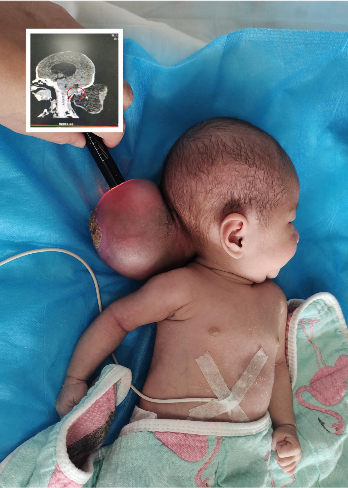 新生儿脑袋有个软软的包,新生儿脑袋上有个包图片