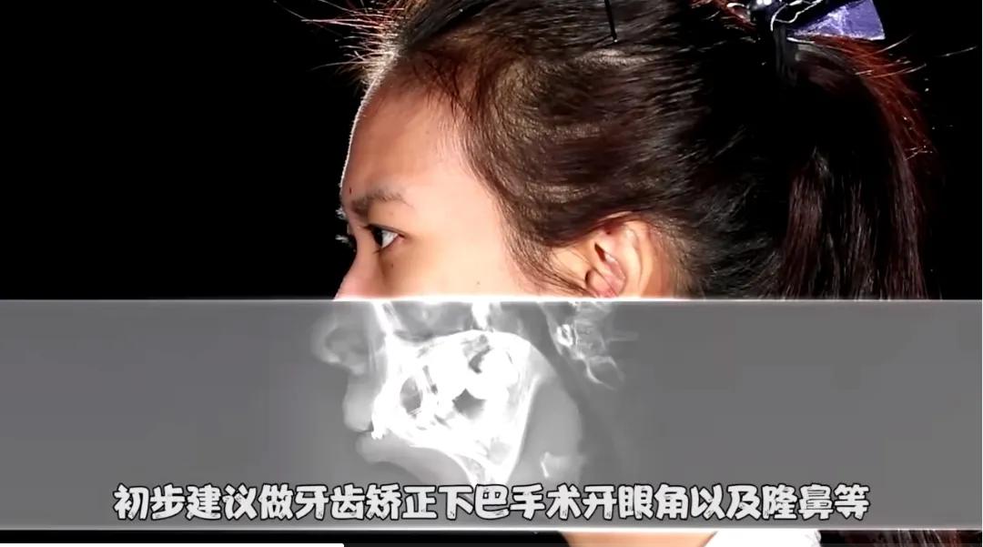 这才是整容存在的意义泰国美女天生没有下巴，整容后迎来全新人生