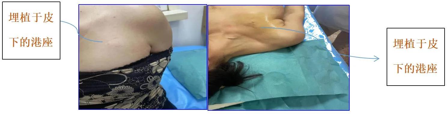 隐形的输液工具——输液港，中长期输液患者的最佳选择