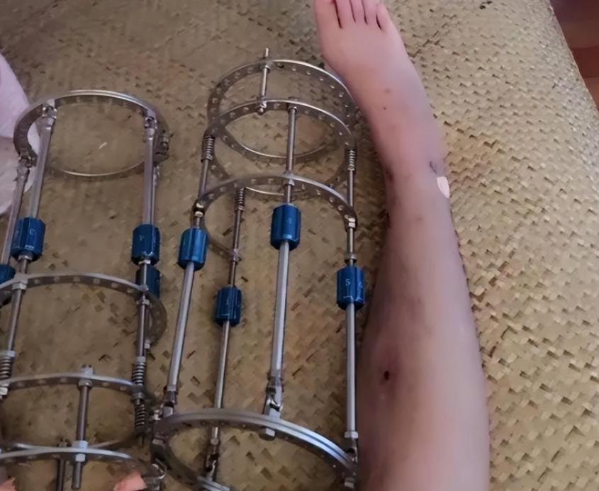 李亚诺中国断骨增高第一人,当年花16万断腿增高