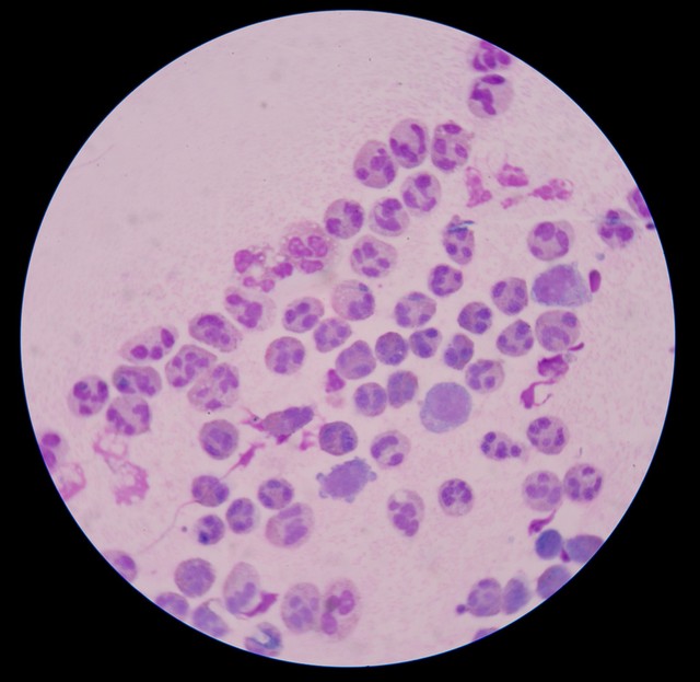 白细胞增多是白血病还是感染,白细胞明显增多是白血病吗