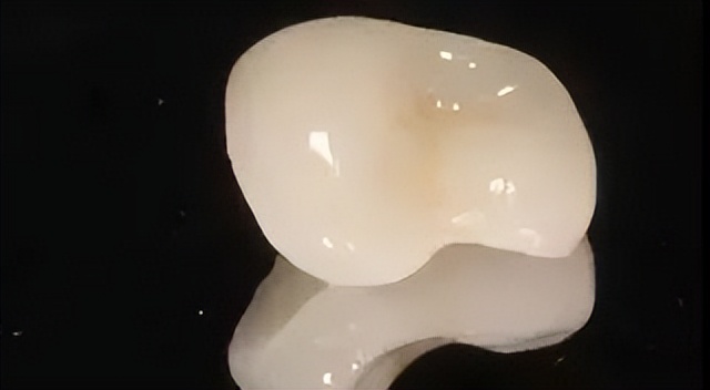 补牙跟嵌体有什么区别哪个更牢固,补牙为什么非要根管