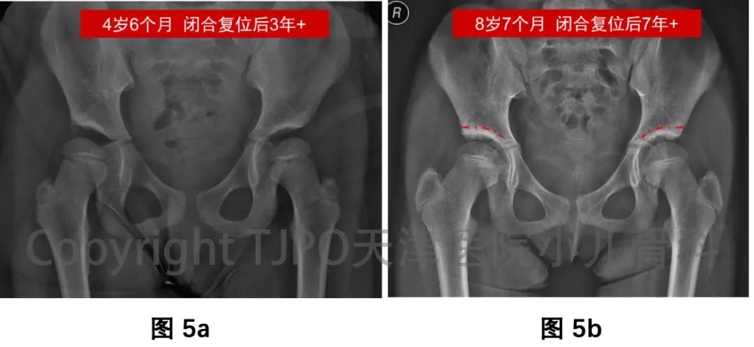 髋关节发育不良做完截骨术,髋关节发育不良截骨矫正能撑多久